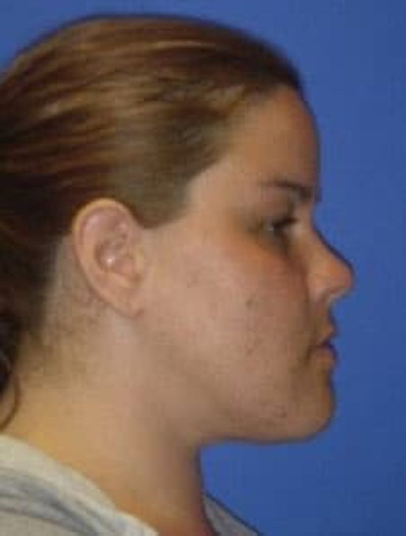 Neck Liposuction Before & After Gallery - Patient 547257 - Image 2