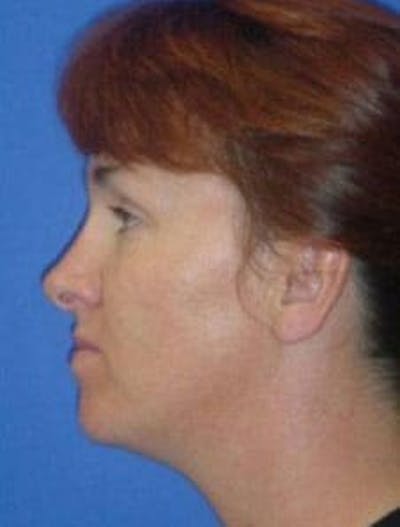 Neck Liposuction Before & After Gallery - Patient 686130 - Image 1
