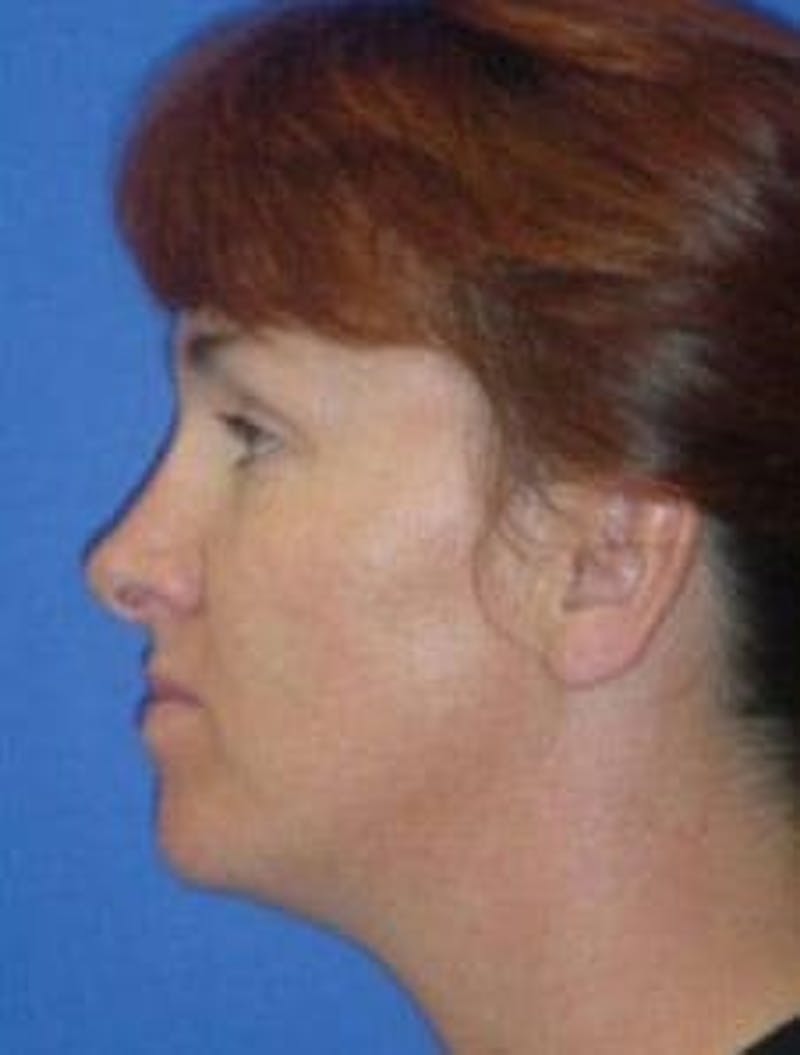 Neck Liposuction Before & After Gallery - Patient 686130 - Image 1