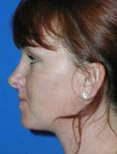 Neck Liposuction Before & After Gallery - Patient 686130 - Image 2