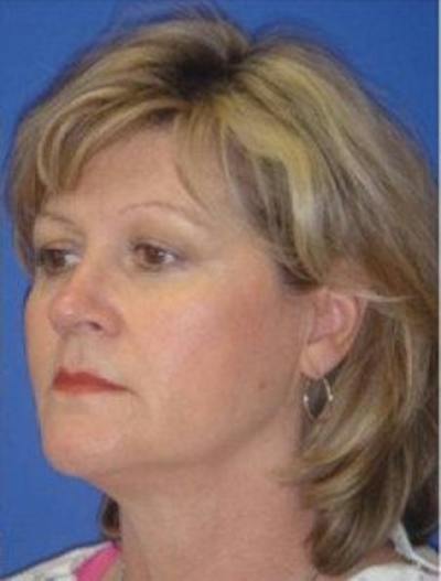 Neck Liposuction Before & After Gallery - Patient 802904 - Image 1