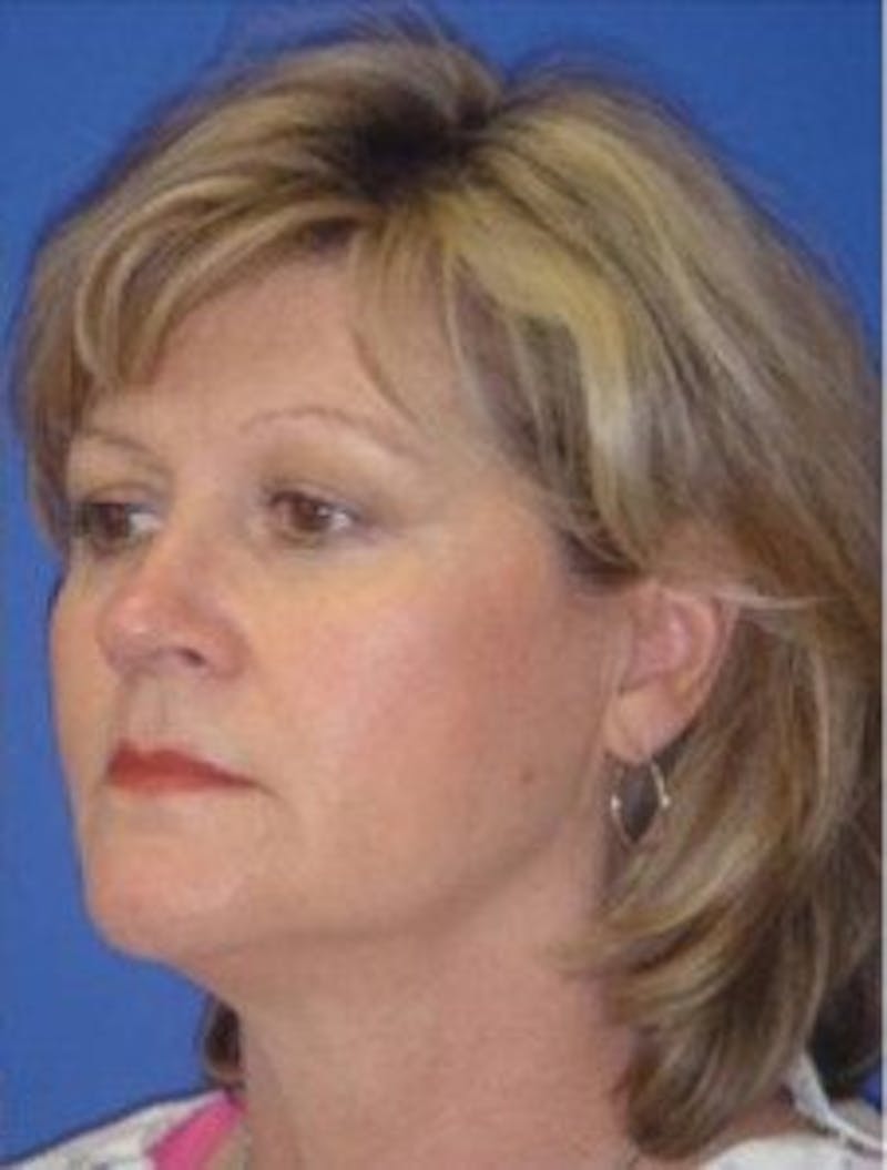 Neck Liposuction Before & After Gallery - Patient 802904 - Image 1