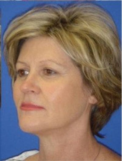 Neck Liposuction Before & After Gallery - Patient 802904 - Image 2