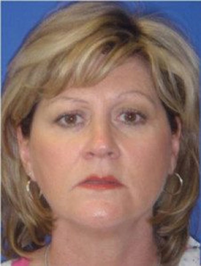 Neck Liposuction Before & After Gallery - Patient 802904 - Image 3