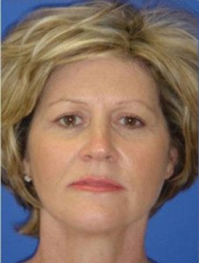 Neck Liposuction Before & After Gallery - Patient 802904 - Image 4