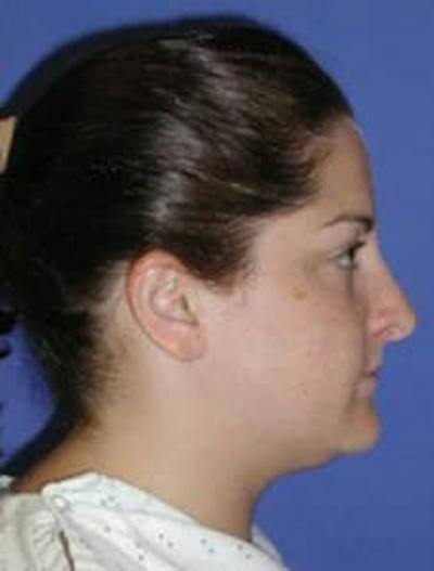 Neck Liposuction Before & After Gallery - Patient 161853 - Image 1