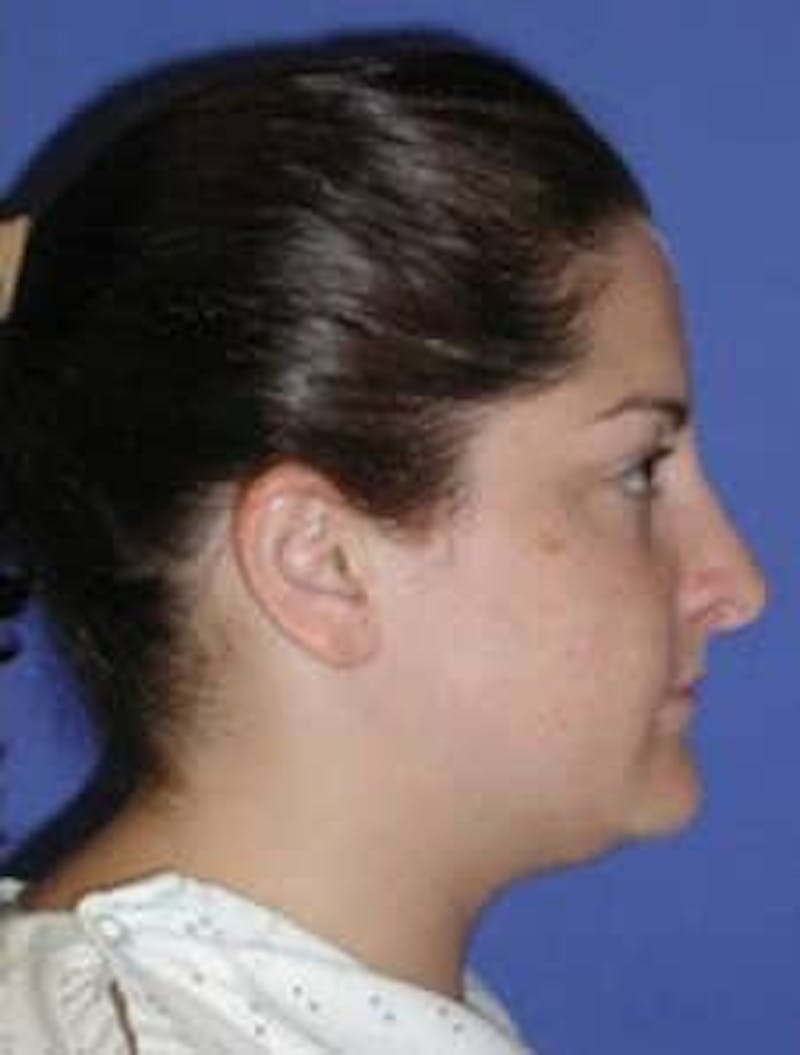 Neck Liposuction Before & After Gallery - Patient 161853 - Image 1