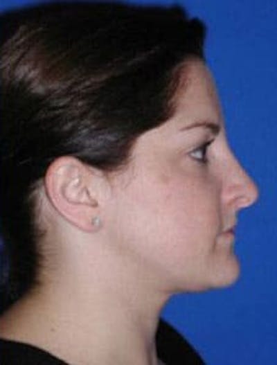 Neck Liposuction Before & After Gallery - Patient 161853 - Image 2