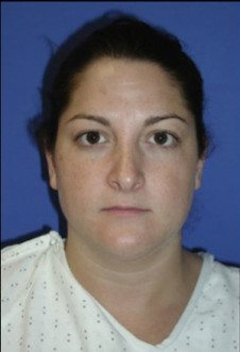Neck Liposuction Before & After Gallery - Patient 161853 - Image 3