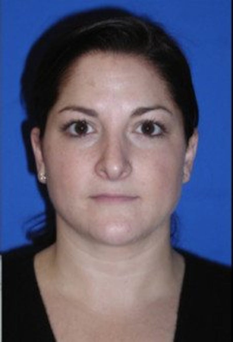 Neck Liposuction Before & After Gallery - Patient 161853 - Image 4
