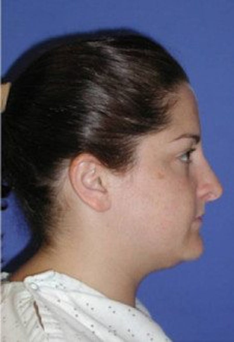 Neck Liposuction Before & After Gallery - Patient 161853 - Image 5