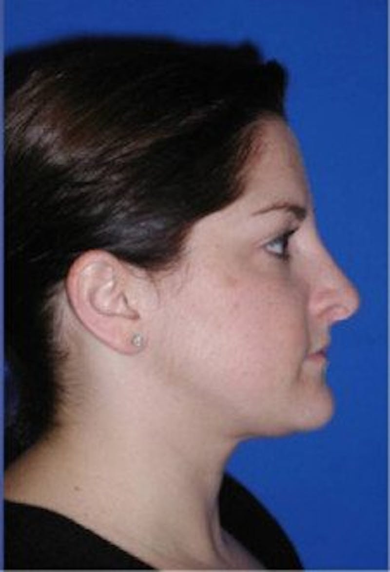 Neck Liposuction Before & After Gallery - Patient 161853 - Image 6