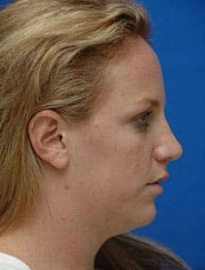 Neck Liposuction Before & After Gallery - Patient 285017 - Image 1