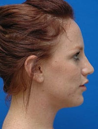Neck Liposuction Before & After Gallery - Patient 285017 - Image 2