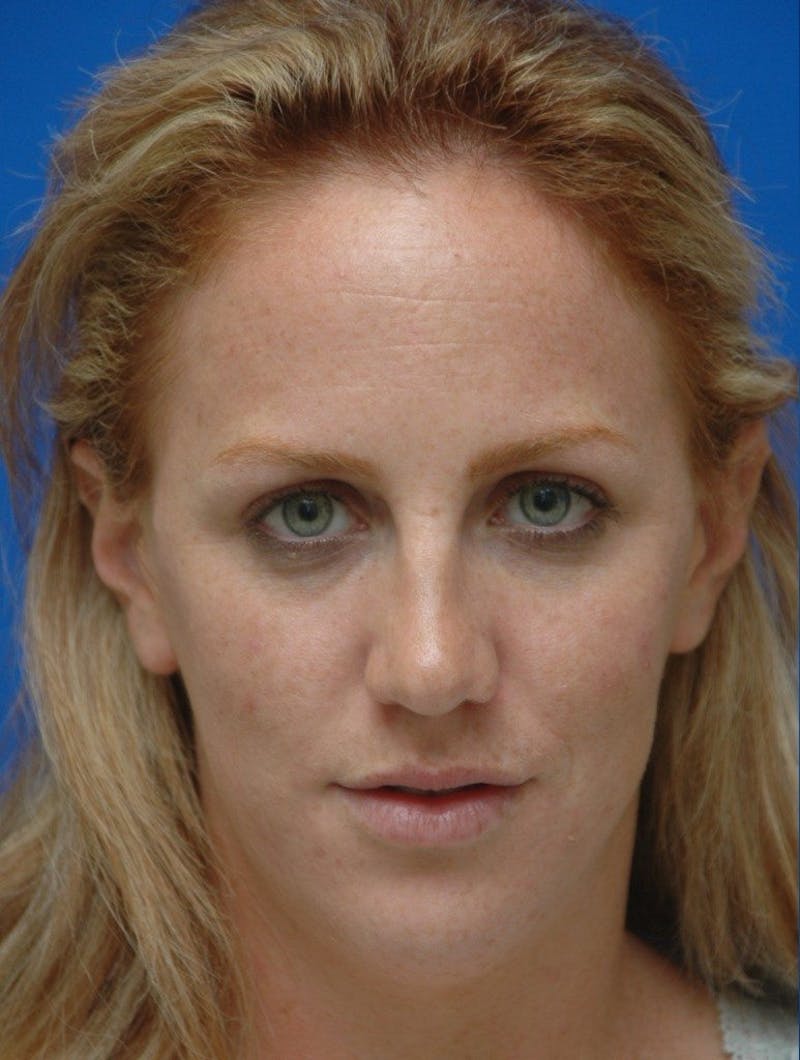 Neck Liposuction Before & After Gallery - Patient 285017 - Image 3