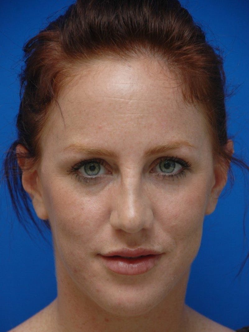 Neck Liposuction Before & After Gallery - Patient 285017 - Image 4