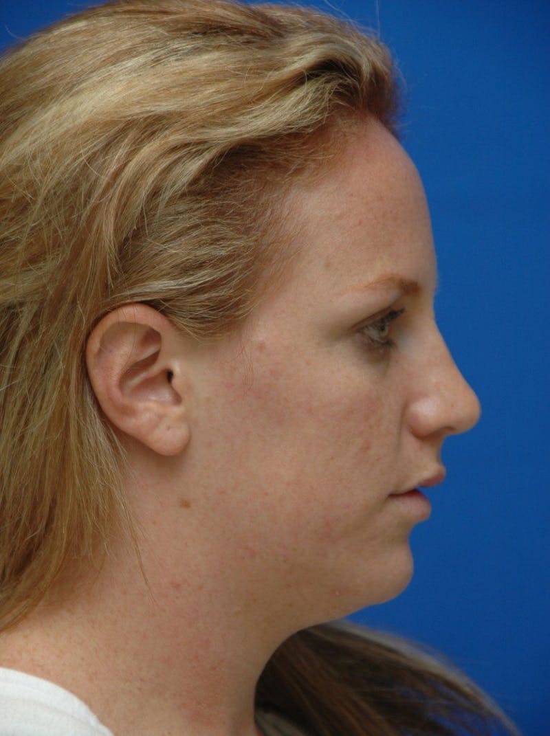 Neck Liposuction Before & After Gallery - Patient 285017 - Image 5