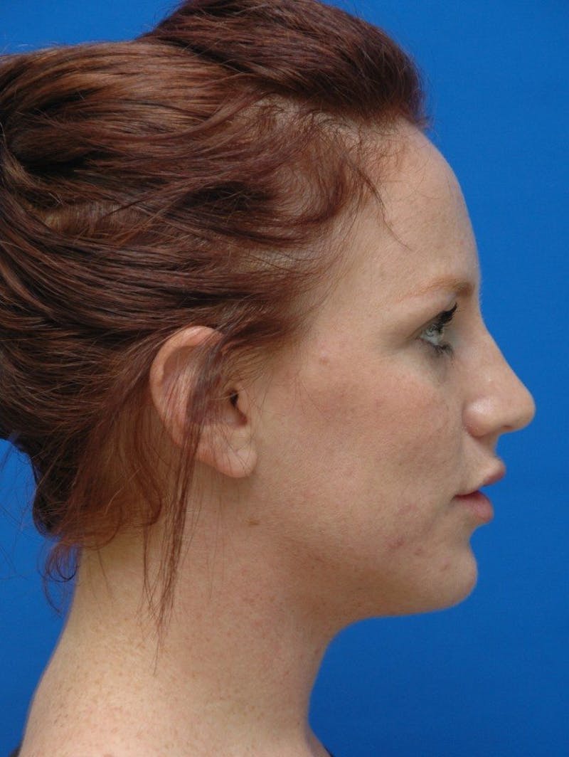 Neck Liposuction Before & After Gallery - Patient 285017 - Image 6