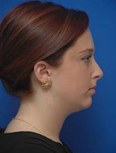 Neck Liposuction Before & After Gallery - Patient 285943 - Image 1