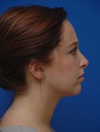 Neck Liposuction Before & After Gallery - Patient 285943 - Image 2