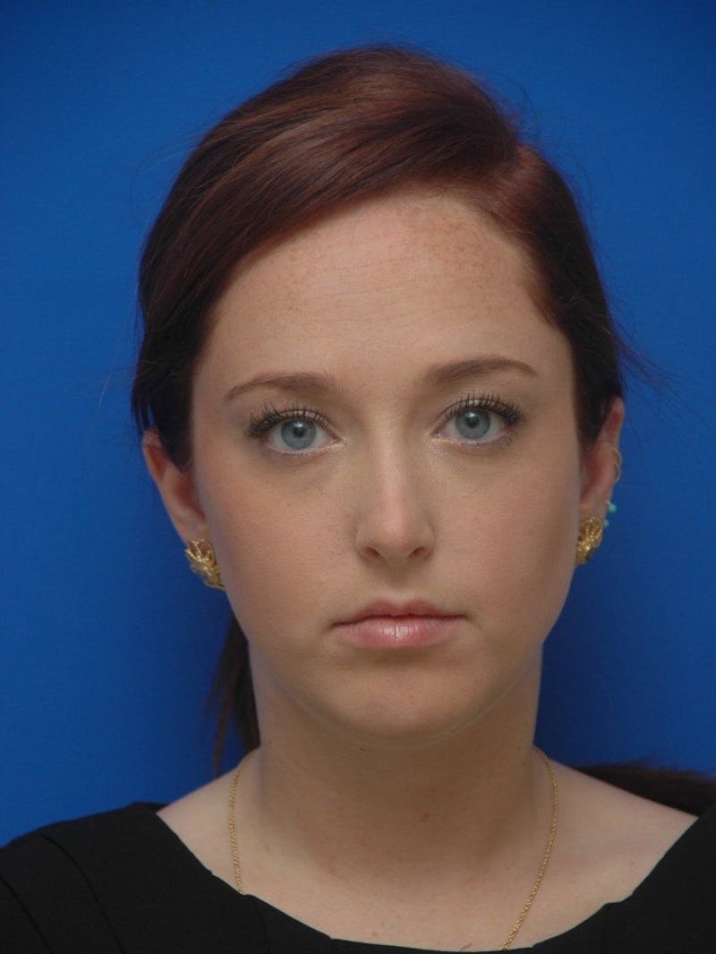 Neck Liposuction Before & After Gallery - Patient 285943 - Image 3