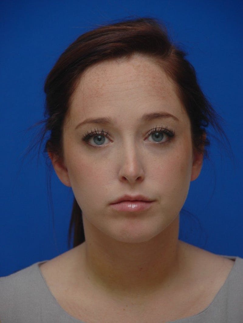 Neck Liposuction Before & After Gallery - Patient 285943 - Image 4