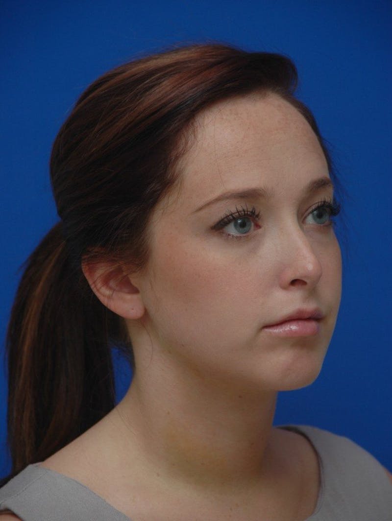 Neck Liposuction Before & After Gallery - Patient 285943 - Image 6