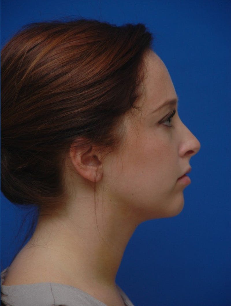 Neck Liposuction Before & After Gallery - Patient 285943 - Image 8