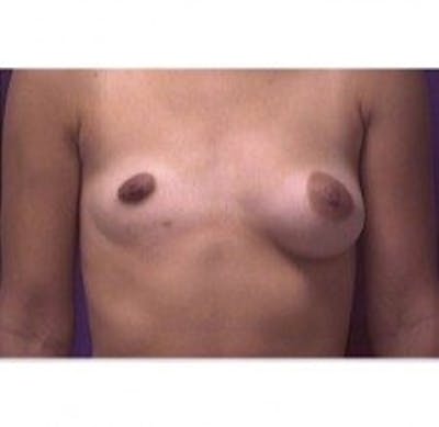 Breast Asymmetry Before & After Gallery - Patient 118054 - Image 1