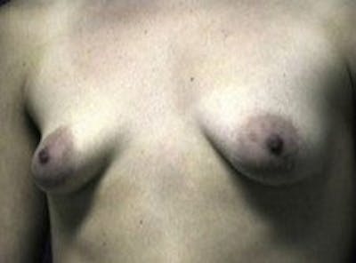 Breast Asymmetry Before & After Gallery - Patient 349767 - Image 1