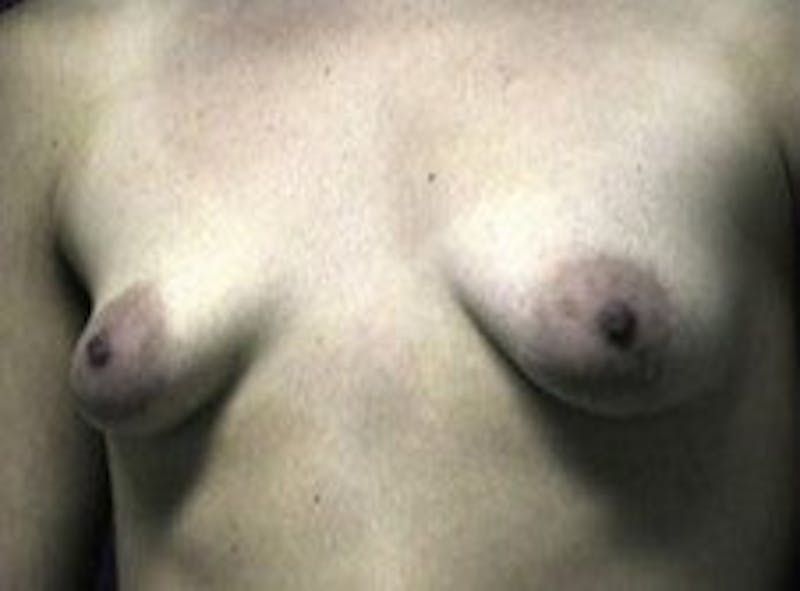 Breast Asymmetry Before & After Gallery - Patient 349767 - Image 1