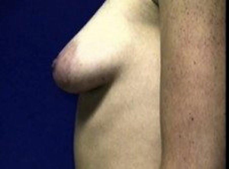 Breast Asymmetry Before & After Gallery - Patient 349767 - Image 3