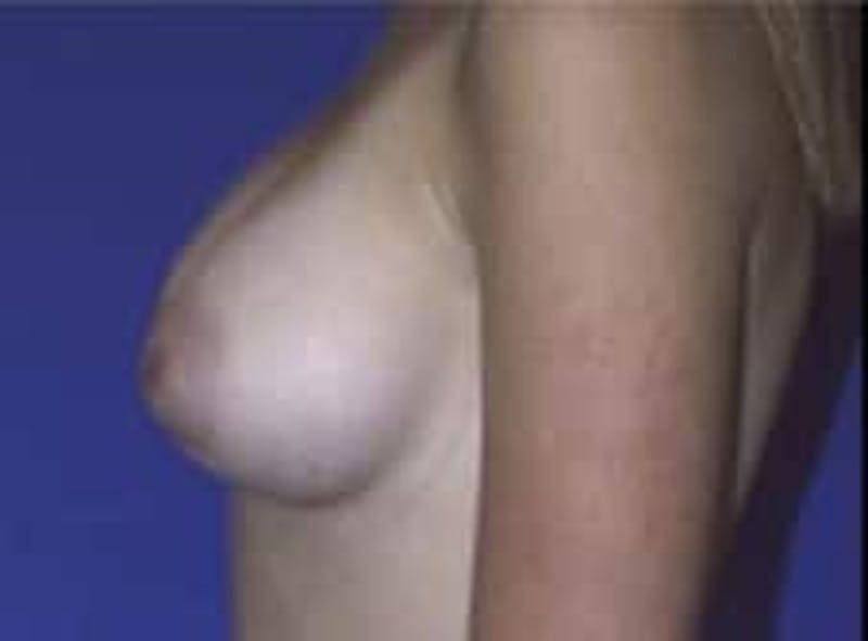 Breast Asymmetry Before & After Gallery - Patient 349767 - Image 4