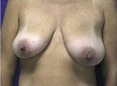 Breast Asymmetry Before & After Gallery - Patient 769739 - Image 1