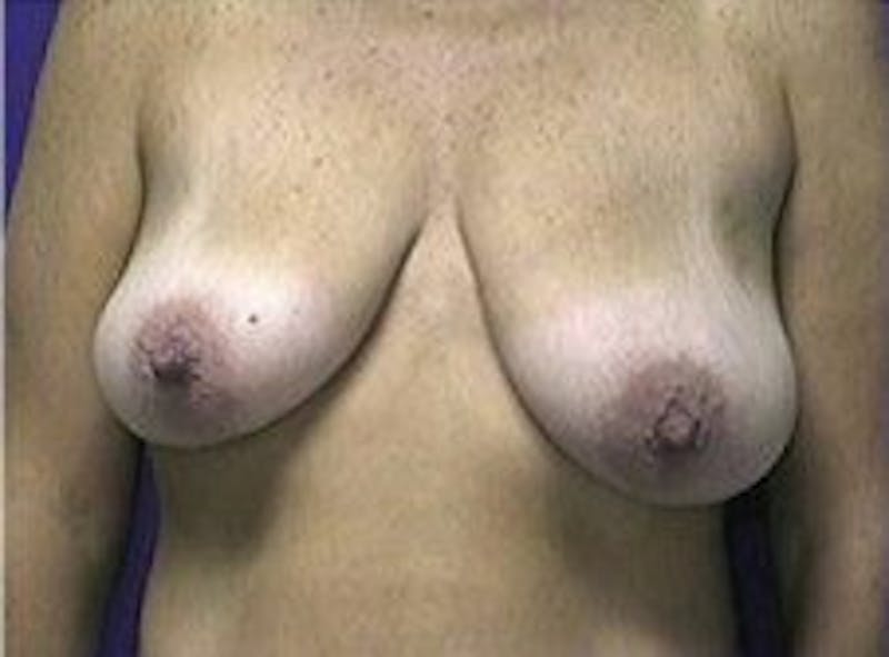 Breast Asymmetry Before & After Gallery - Patient 769739 - Image 1