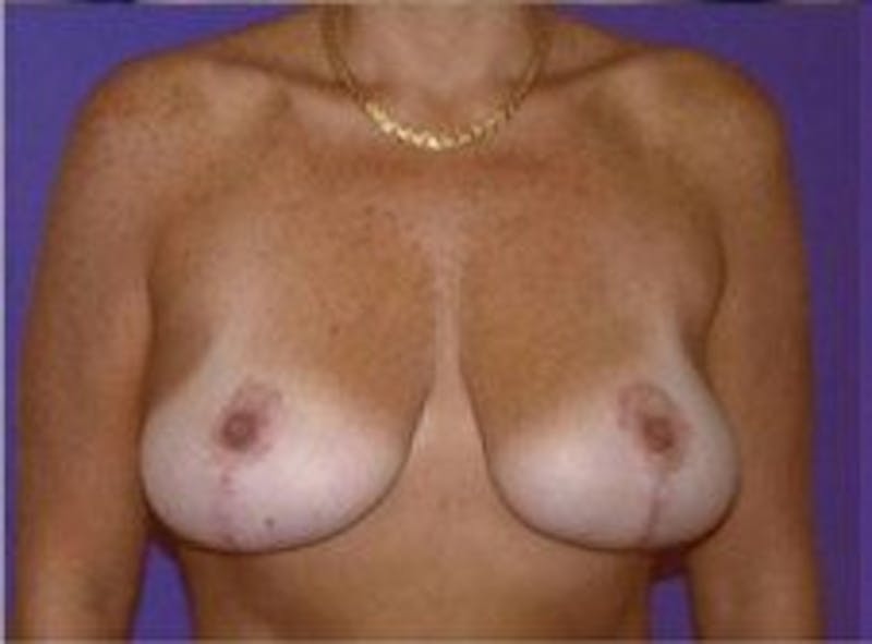 Breast Asymmetry Before & After Gallery - Patient 769739 - Image 2