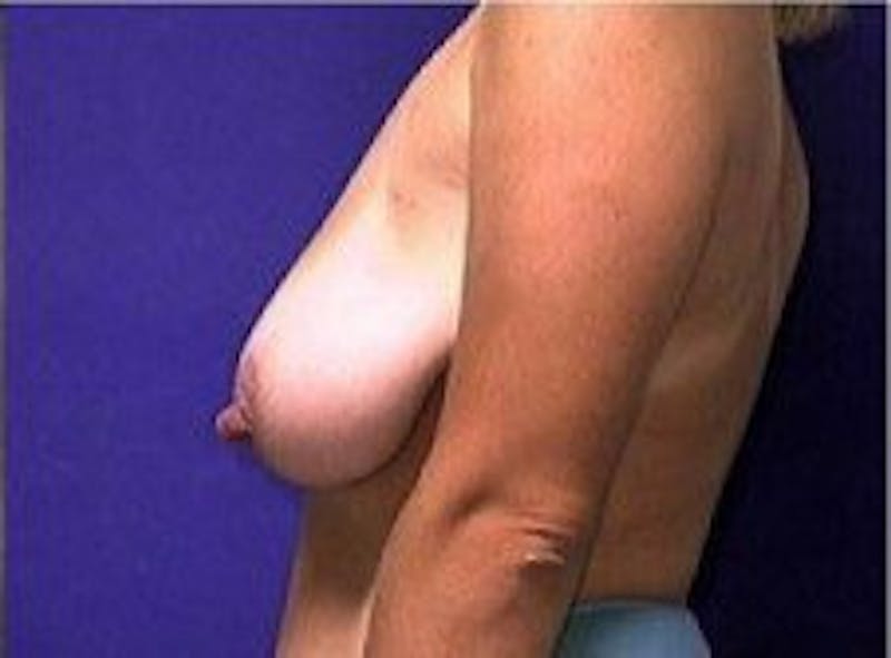 Breast Asymmetry Before & After Gallery - Patient 769739 - Image 3