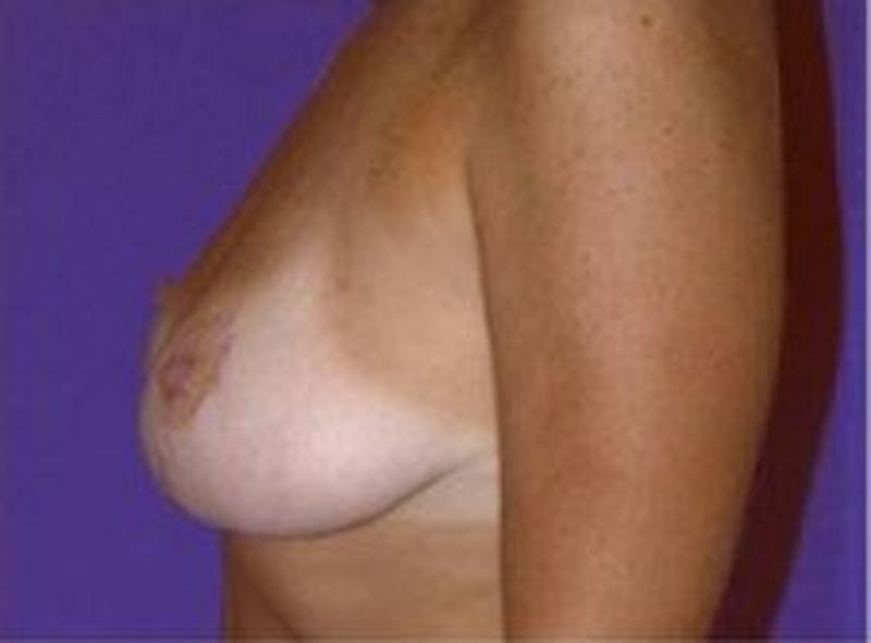 Breast Asymmetry Before & After Gallery - Patient 769739 - Image 4