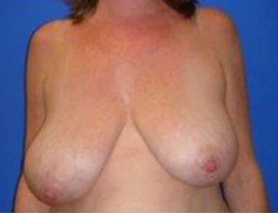 Breast Asymmetry Before & After Gallery - Patient 288962 - Image 1