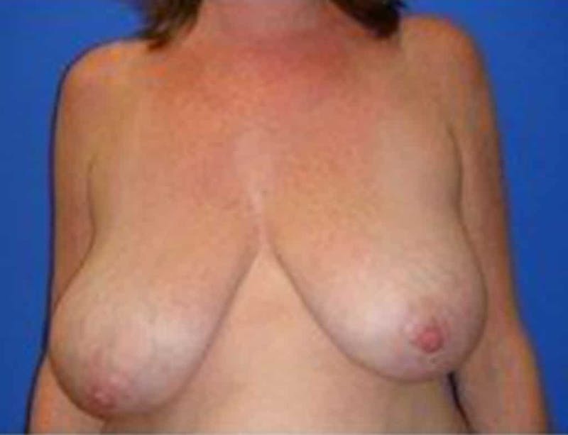 Breast Asymmetry Before & After Gallery - Patient 288962 - Image 1