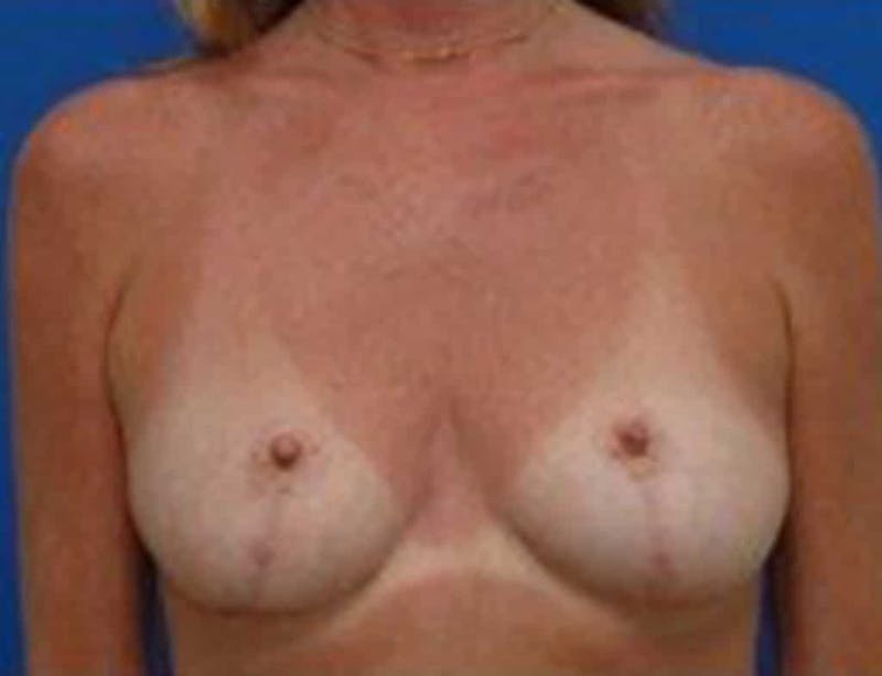 Breast Asymmetry Before & After Gallery - Patient 288962 - Image 2
