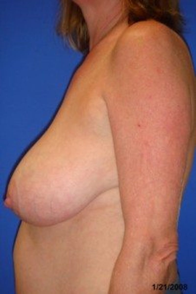 Breast Asymmetry Before & After Gallery - Patient 288962 - Image 3