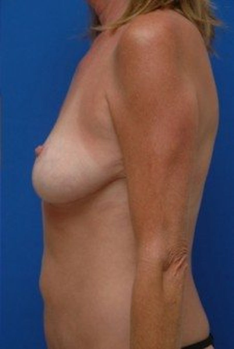 Breast Asymmetry Before & After Gallery - Patient 288962 - Image 4