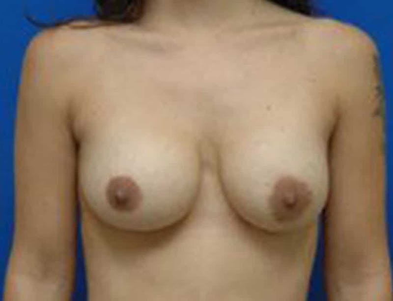 Breast Asymmetry Before & After Gallery - Patient 663967 - Image 2