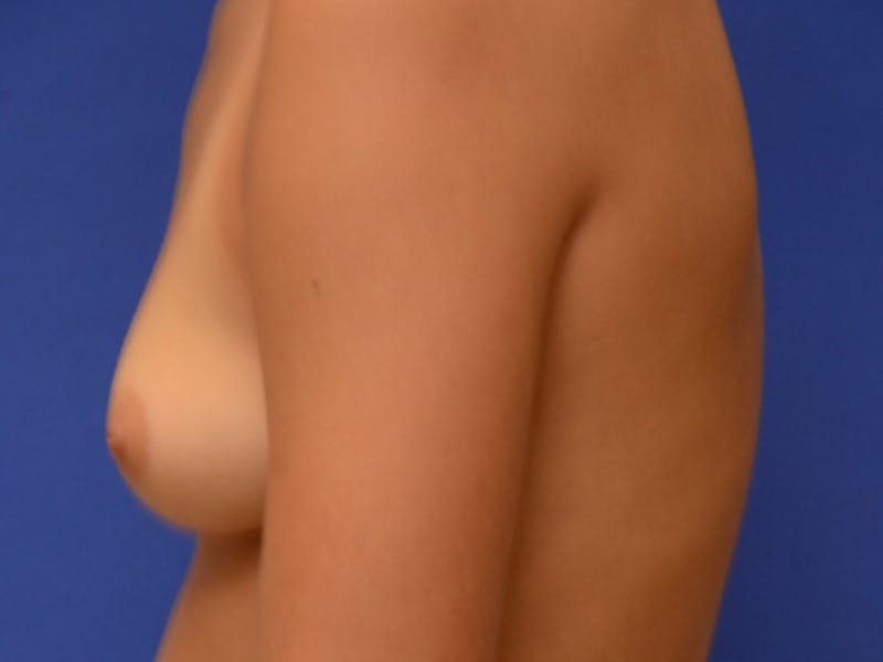Breast Augmentation Before & After Gallery - Patient 194687 - Image 9