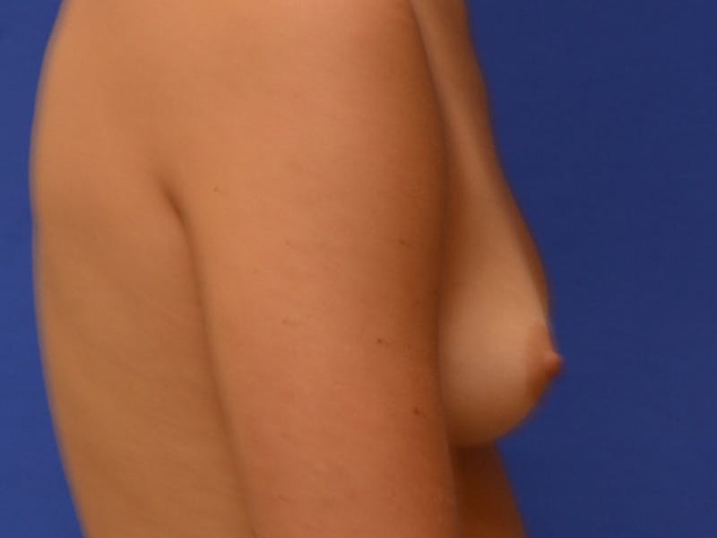 Breast Augmentation Before & After Gallery - Patient 194687 - Image 11