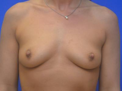 Breast Augmentation Before & After Gallery - Patient 253954 - Image 1