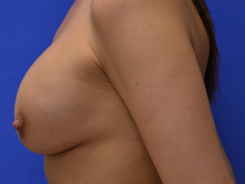 Breast Augmentation Before & After Gallery - Patient 253954 - Image 12