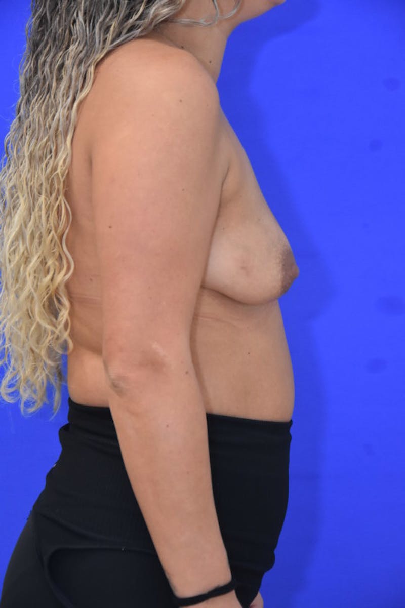 Breast Augmentation Before & After Gallery - Patient 454004 - Image 7