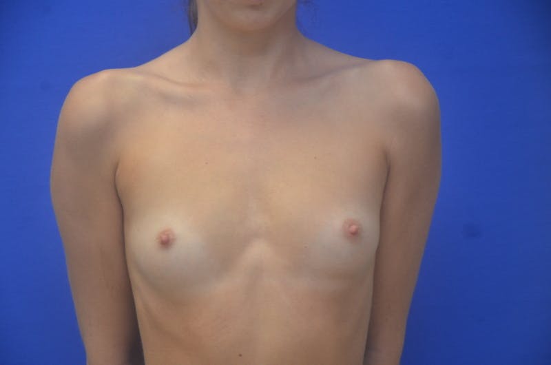 Breast Augmentation Before & After Gallery - Patient 317467 - Image 1